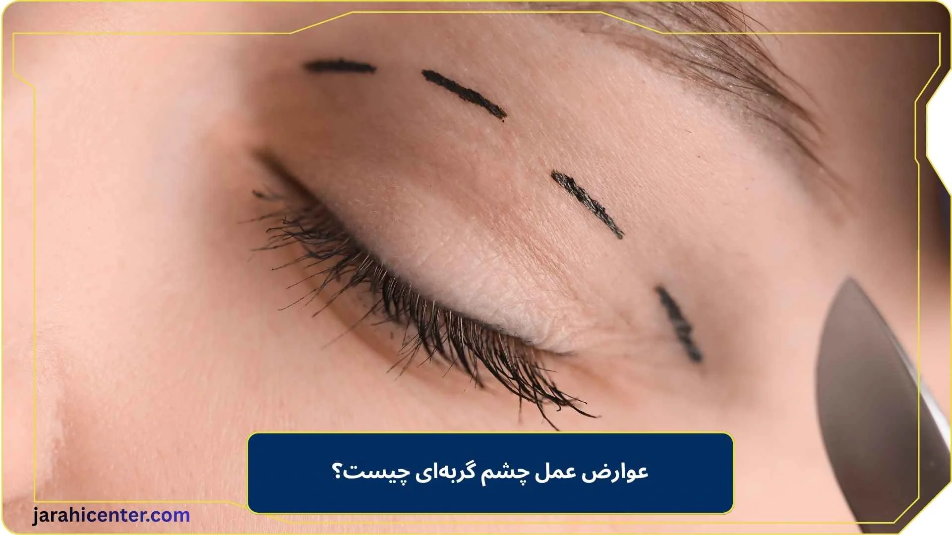 عوارض عمل چشم گربه‌ای چیست؟