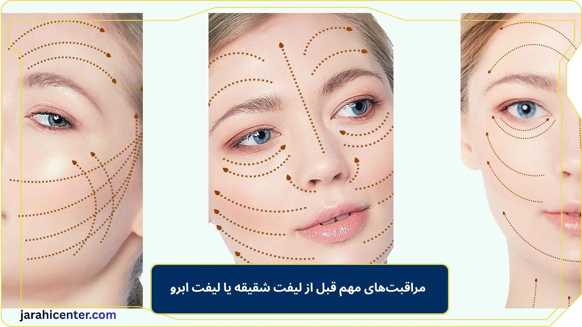 مراقبت‌های مهم قبل از لیفت شقیقه یا لیفت ابرو