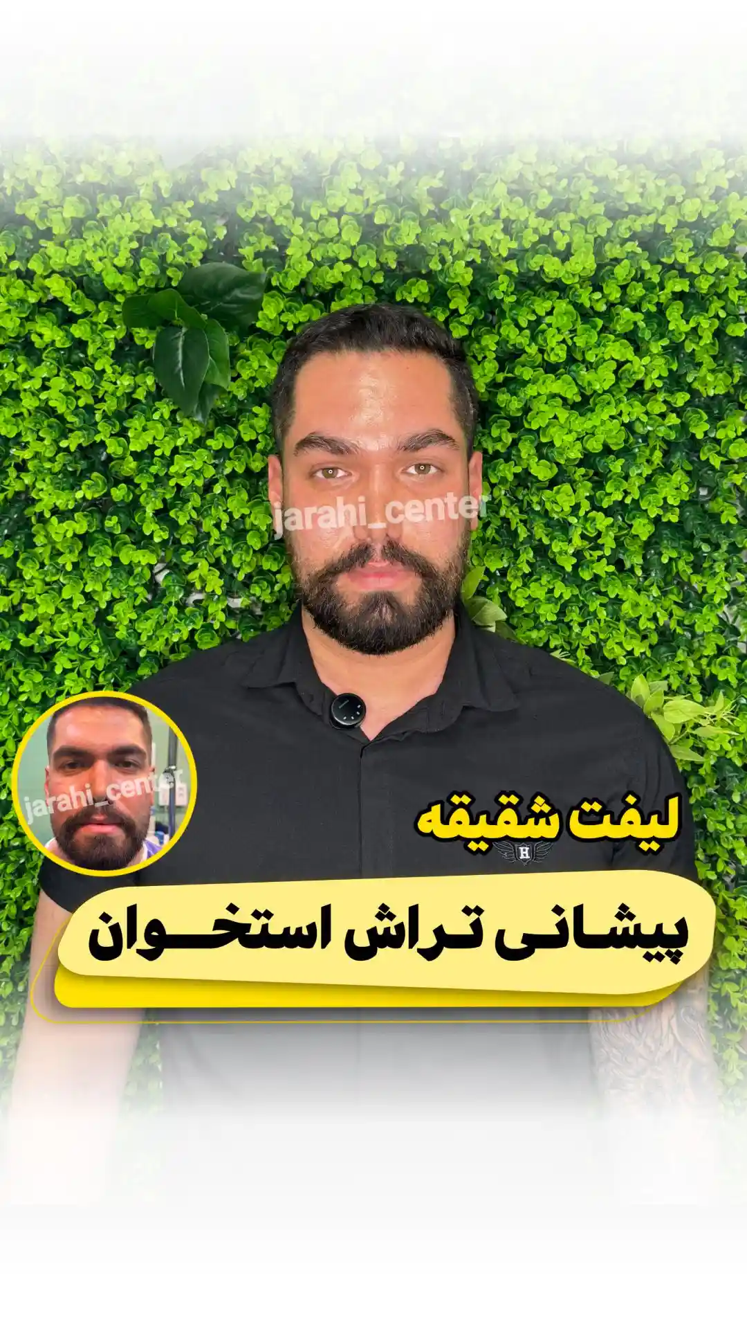 نمونه کار لیفت شقیقه و پیشانی آقایان