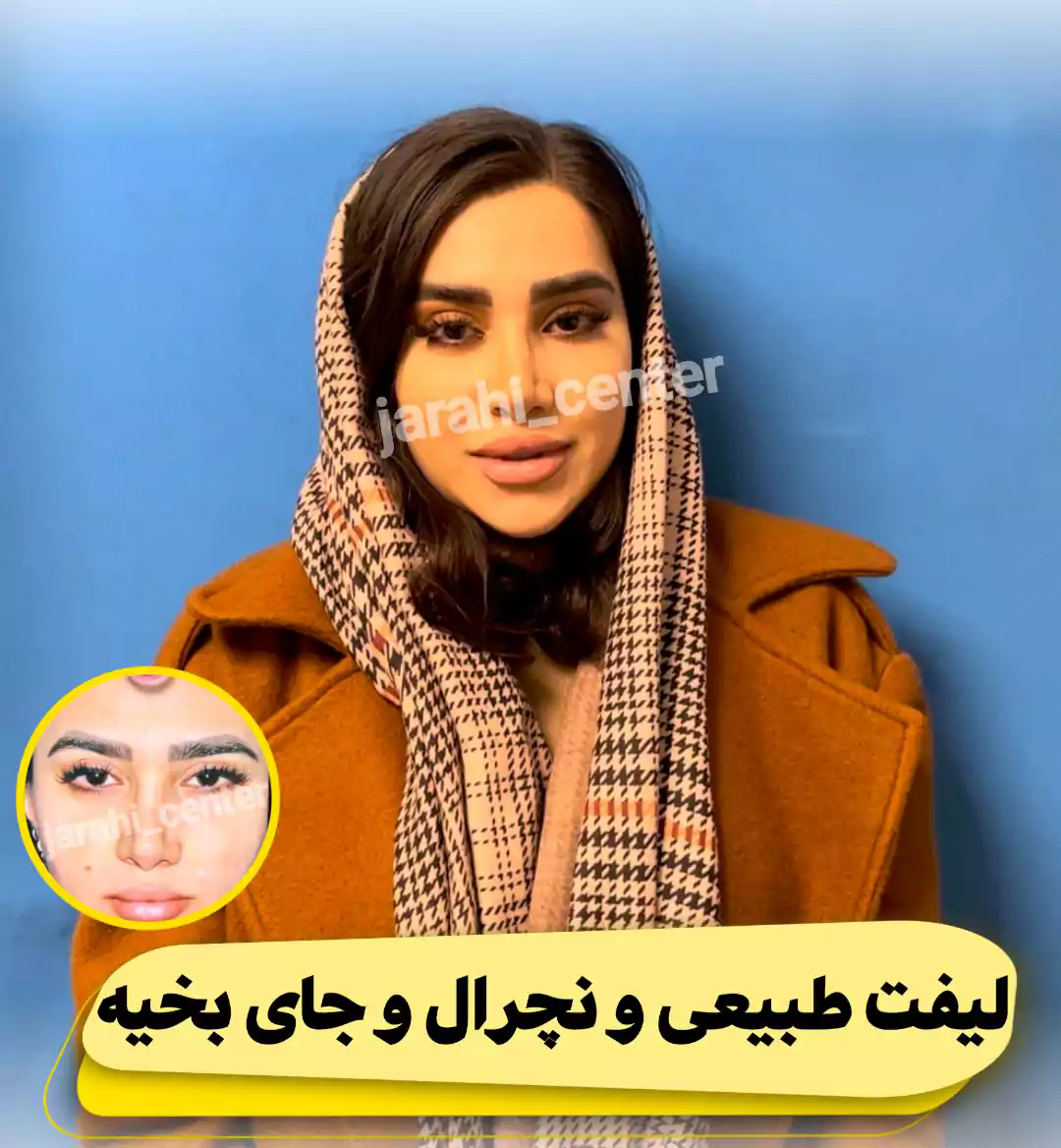 لیفت شقیقه، نیم گونه و پیشانی