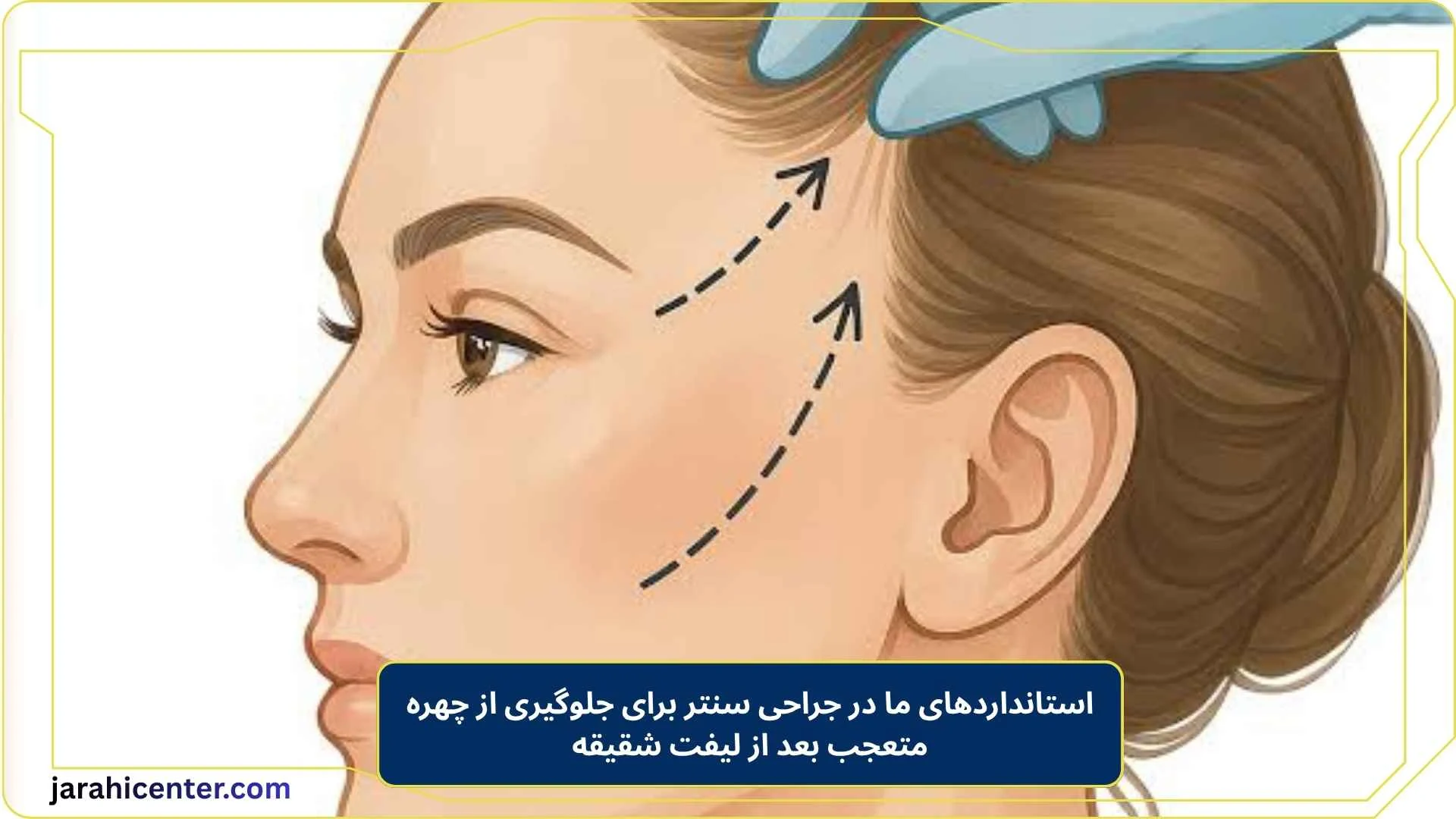 استانداردهای ما در جراحی سنتر برای جلوگیری از چهره متعجب بعد از لیفت شقیقه 
