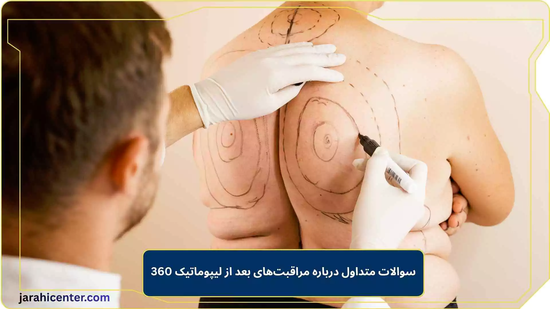 سوالات متداول درباره مراقبت‌های بعد از لیپوماتیک 360