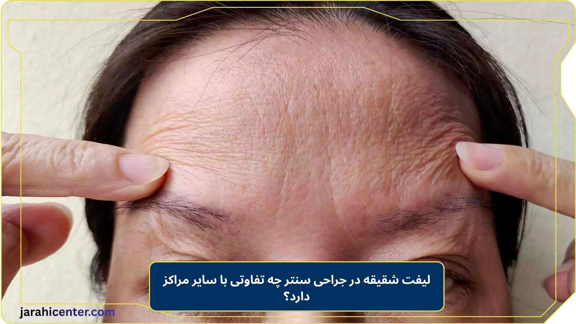 لیفت شقیقه در جراحی سنتر چه تفاوتی با سایر مراکز دارد؟
