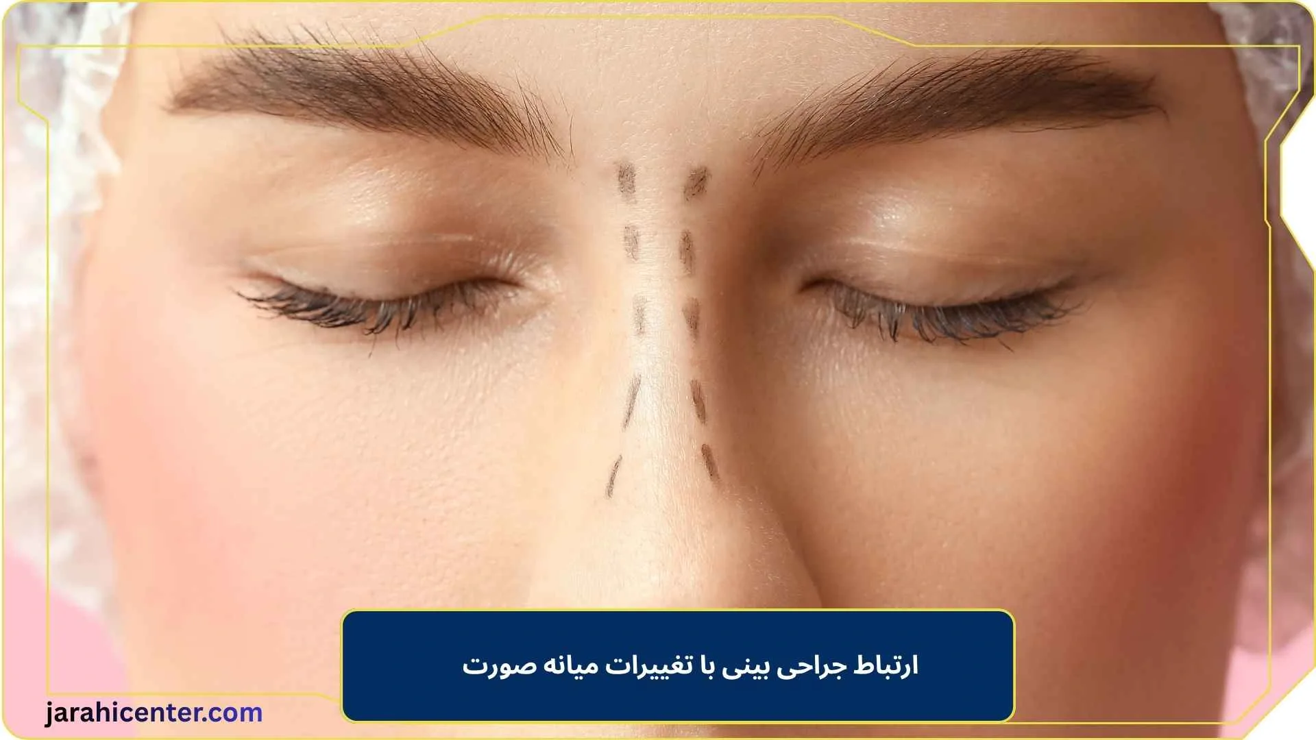 ارتباط جراحی بینی با تغییرات میانه صورت