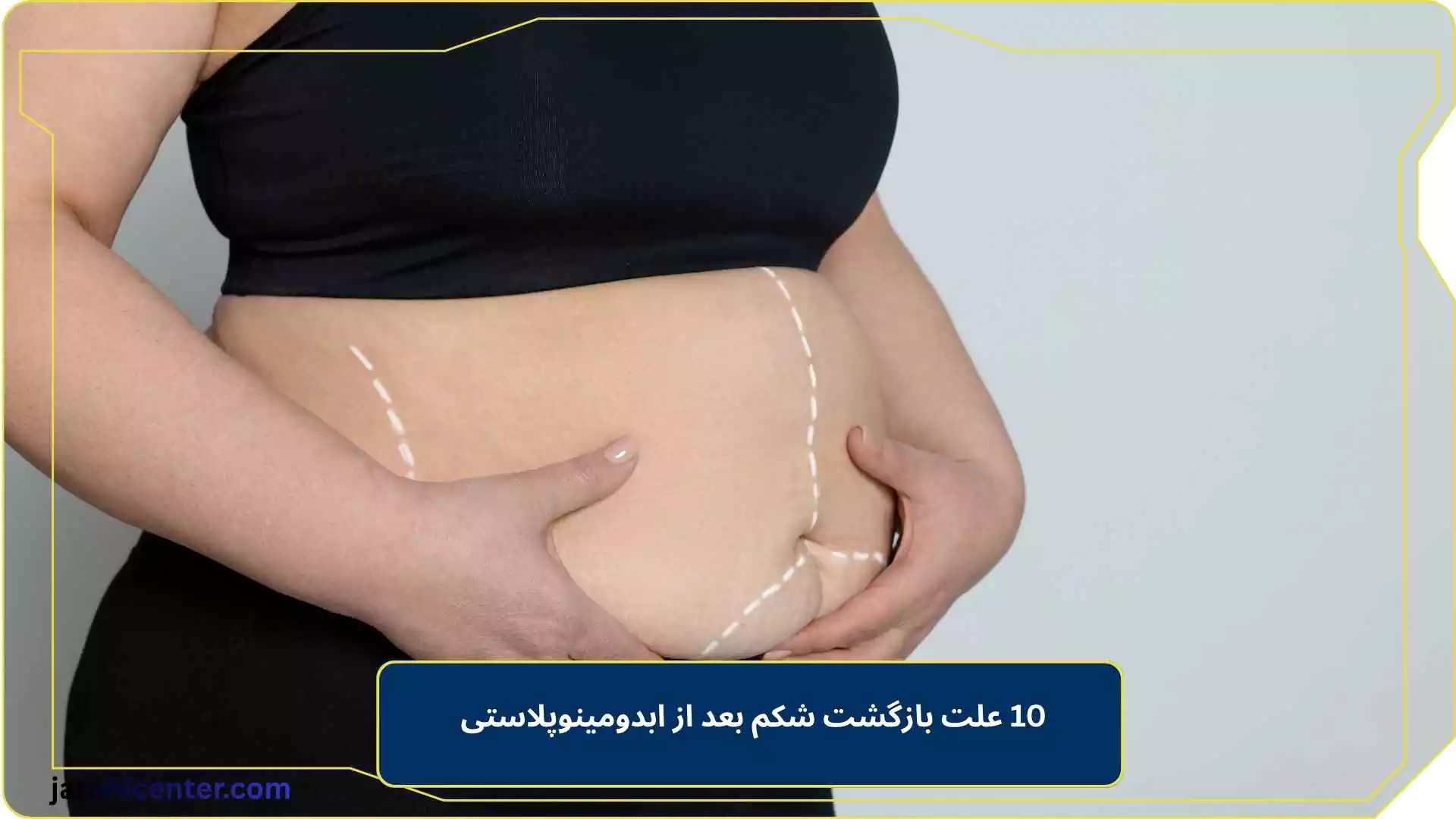 10 علت بازگشت شکم بعد از ابدومینوپلاستی 