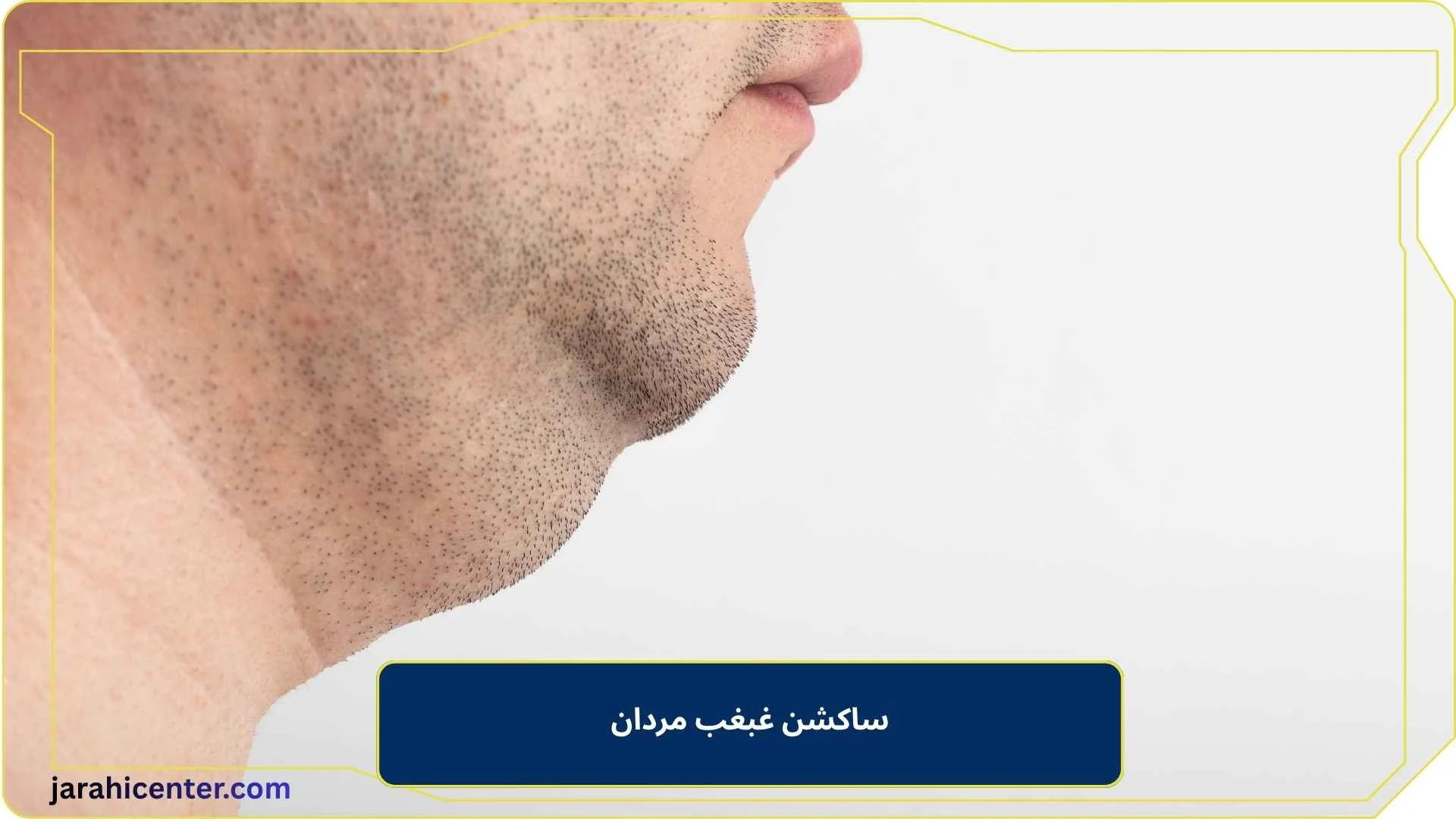 ساکشن غبغب مردان