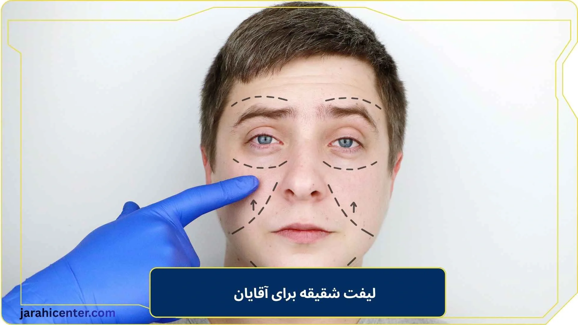 لیفت شقیقه برای آقایان
