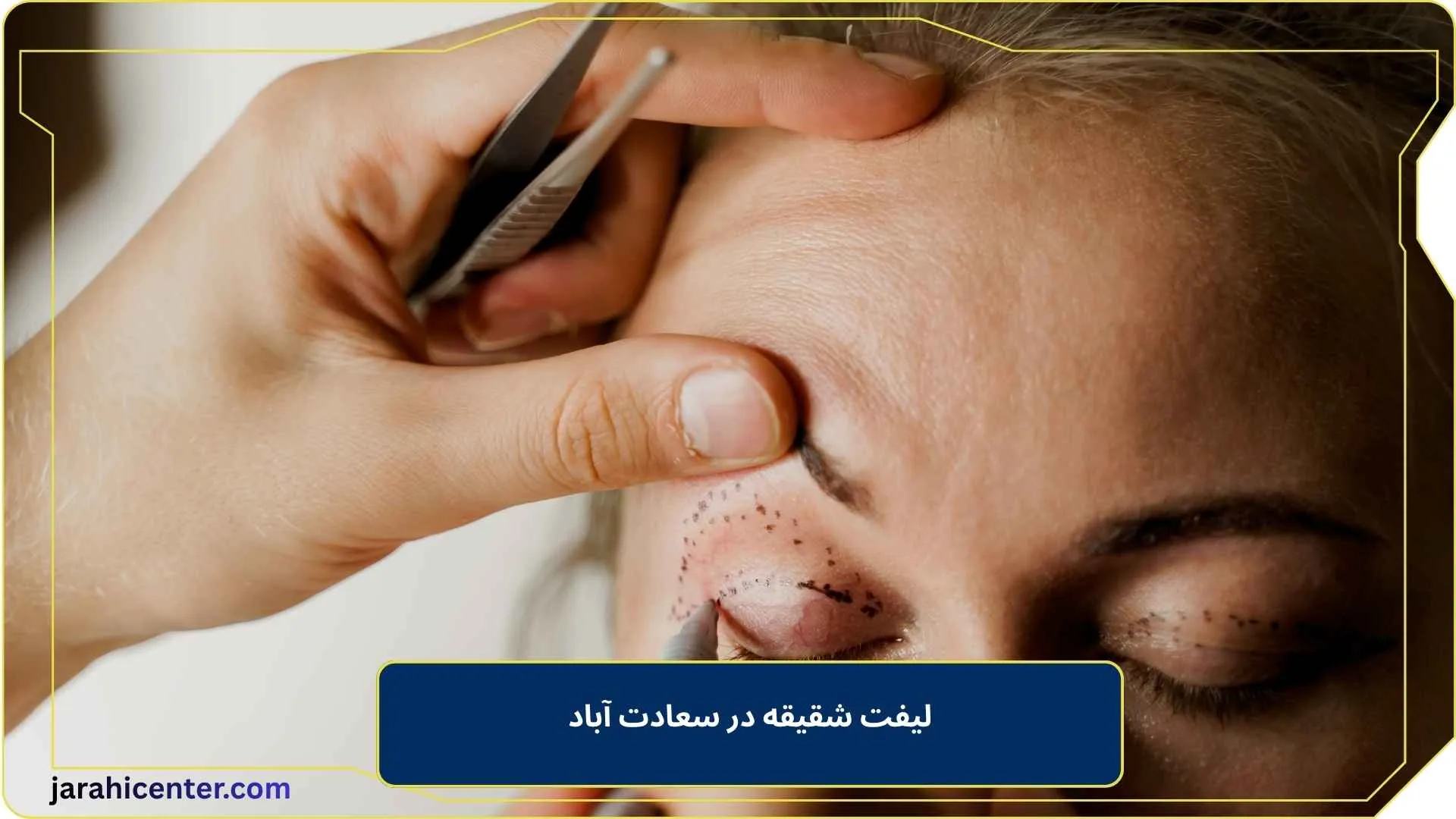 لیفت شقیقه در سعادت آباد
