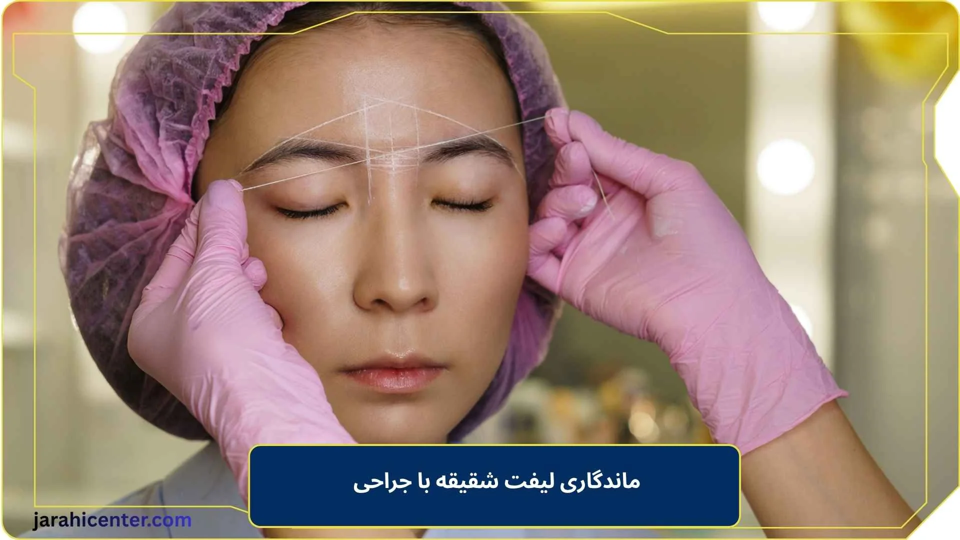 ماندگاری لیفت شقیقه با جراحی 