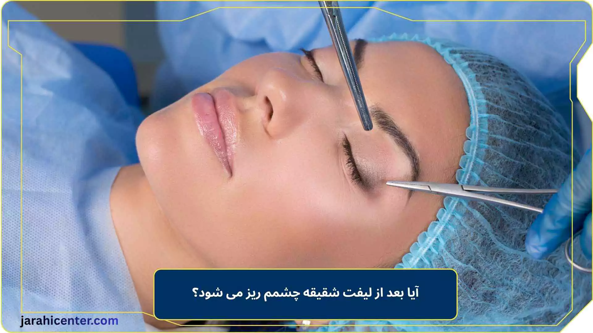 آیا بعد از لیفت شقیقه چشمم ریز می شود؟