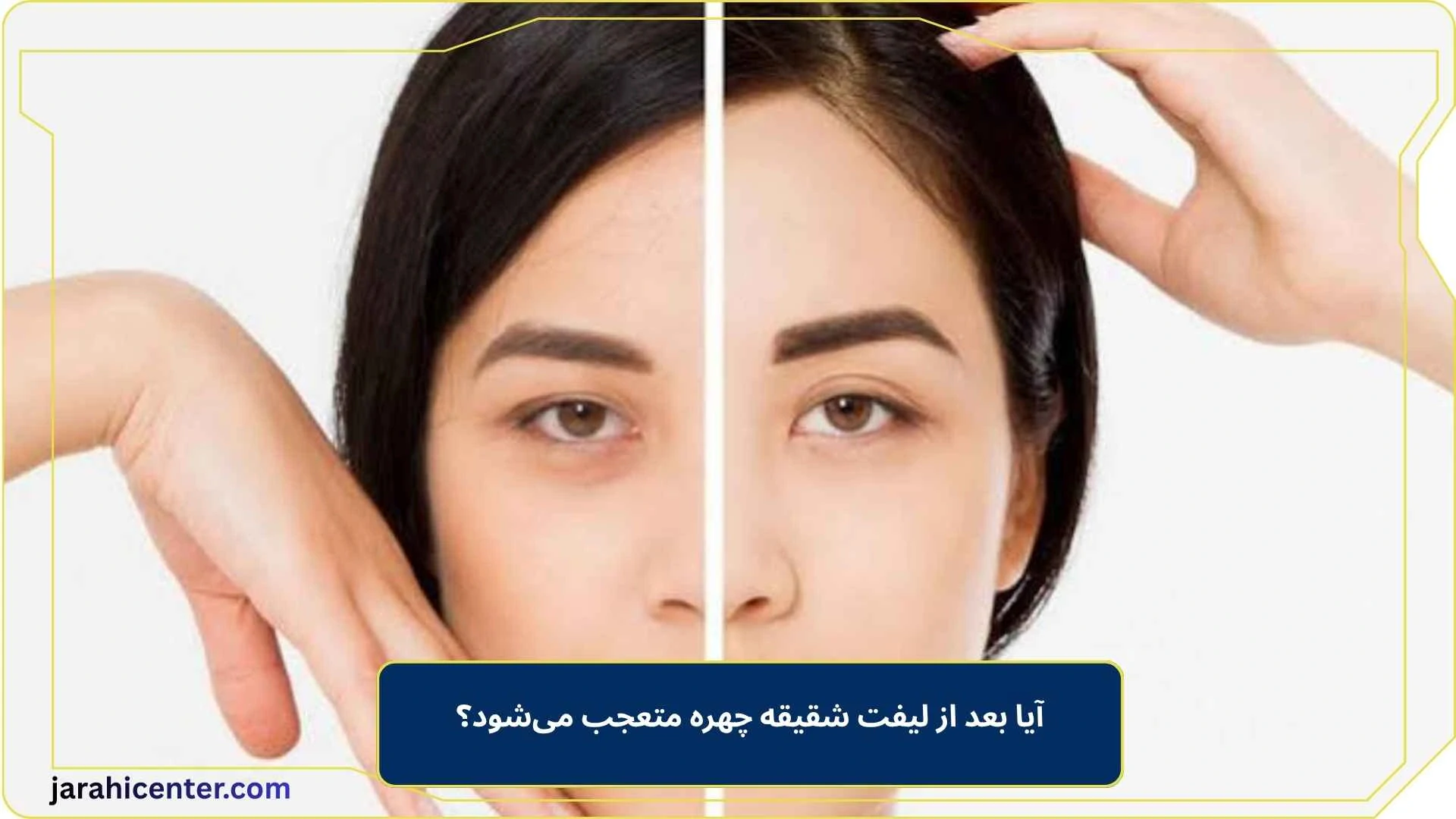 آیا بعد از لیفت شقیقه چهره متعجب می‌شود؟