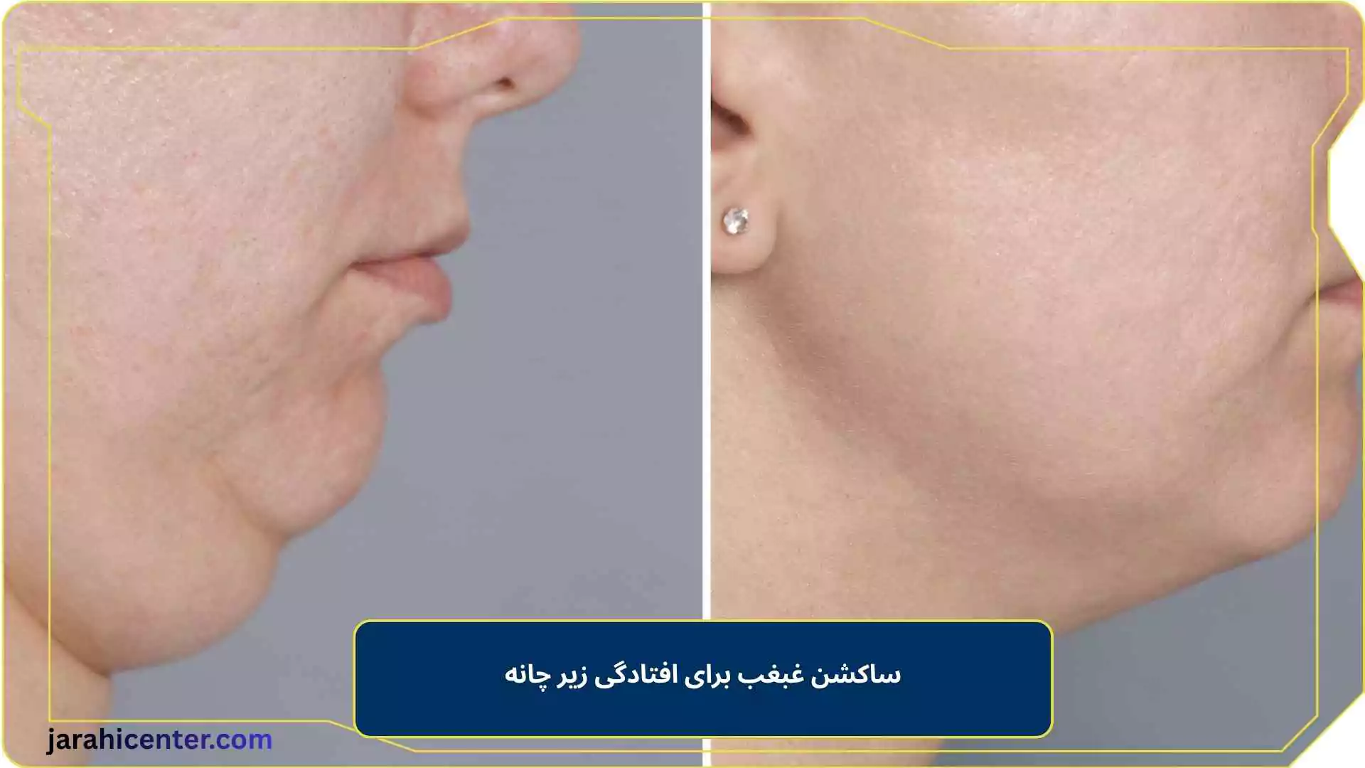 ساکشن غبغب برای افتادگی زیر چانه